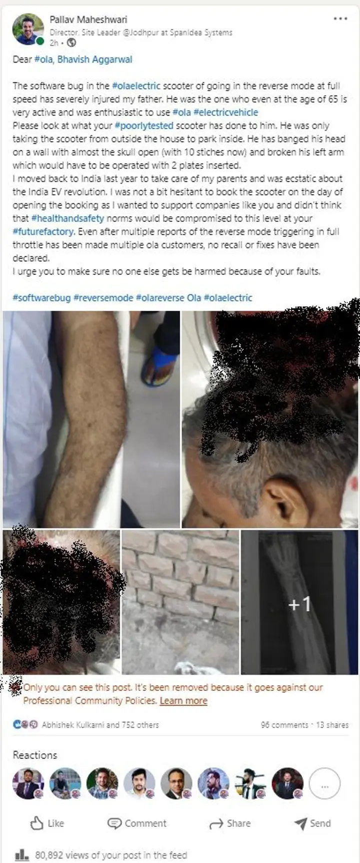 Ola S1 Owner Severely Injured; Scooter Goes Into Reverse Mode At Full Speed